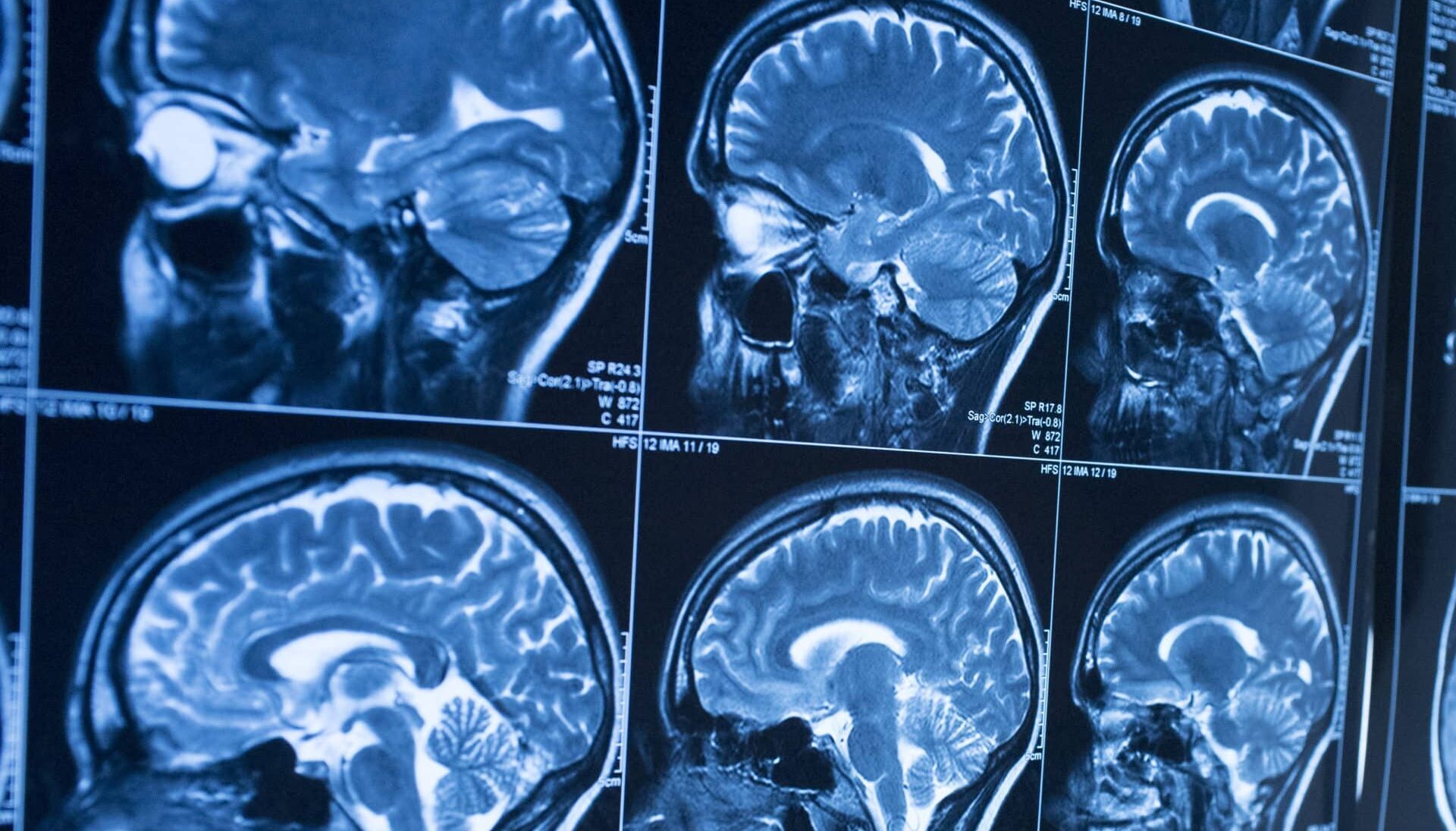 iStock-168715138-mri-scaled